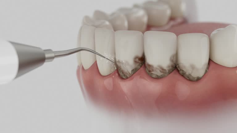 Trusted Dental Crowns And Bridges service in Takoma Park, MD - Dentist Open Now